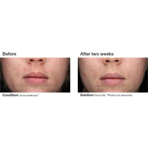 PCA Skin Acne Gel Before &amp; After